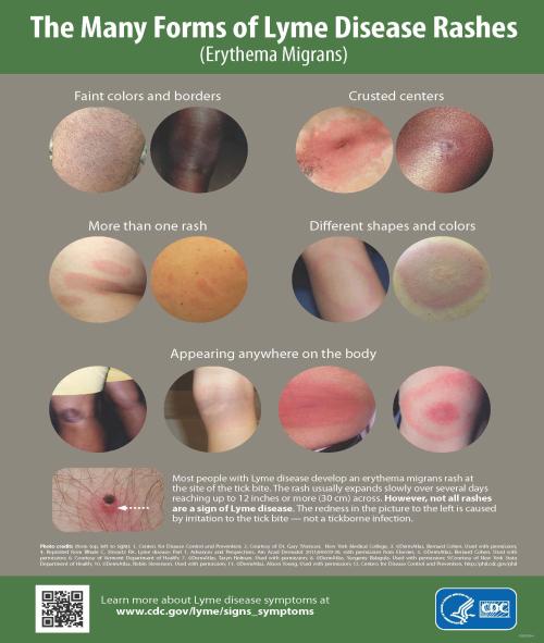 images that show several types of lyme disease rashes on different skin tones