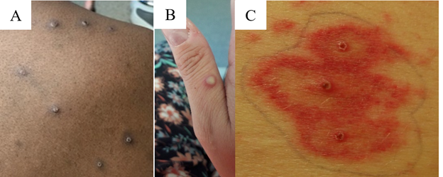 Three images of monkeypox lesions