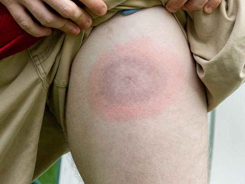 Lyme Disease And Other Diseases Spread By Ticks Health