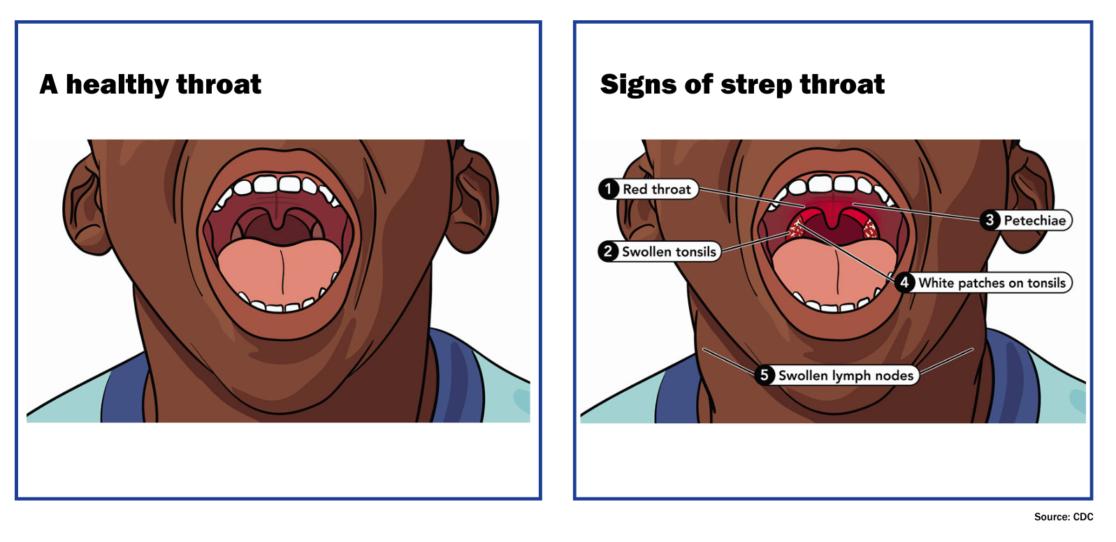 Diagram of a healthy throat compared to a throat with signs of strep throat: 1. red throat, 2 swollen tonsils, 3. petechiae, 4. white patched on tonsils 5. swollen lymph nodes.