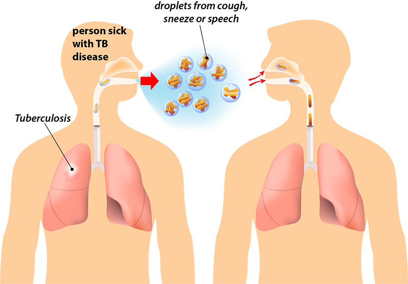 Tuberculosis spreading from one male figure by cough or sneeze to the other male figure