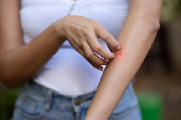 Woman scratching arm after bug bite